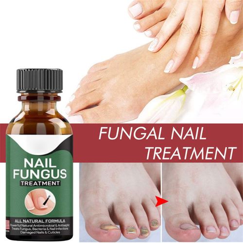 Fast Nail Fungal Treatments